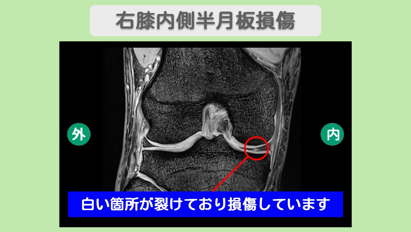 右膝内側半月板損傷
