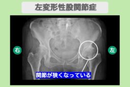 左変形性股関節症