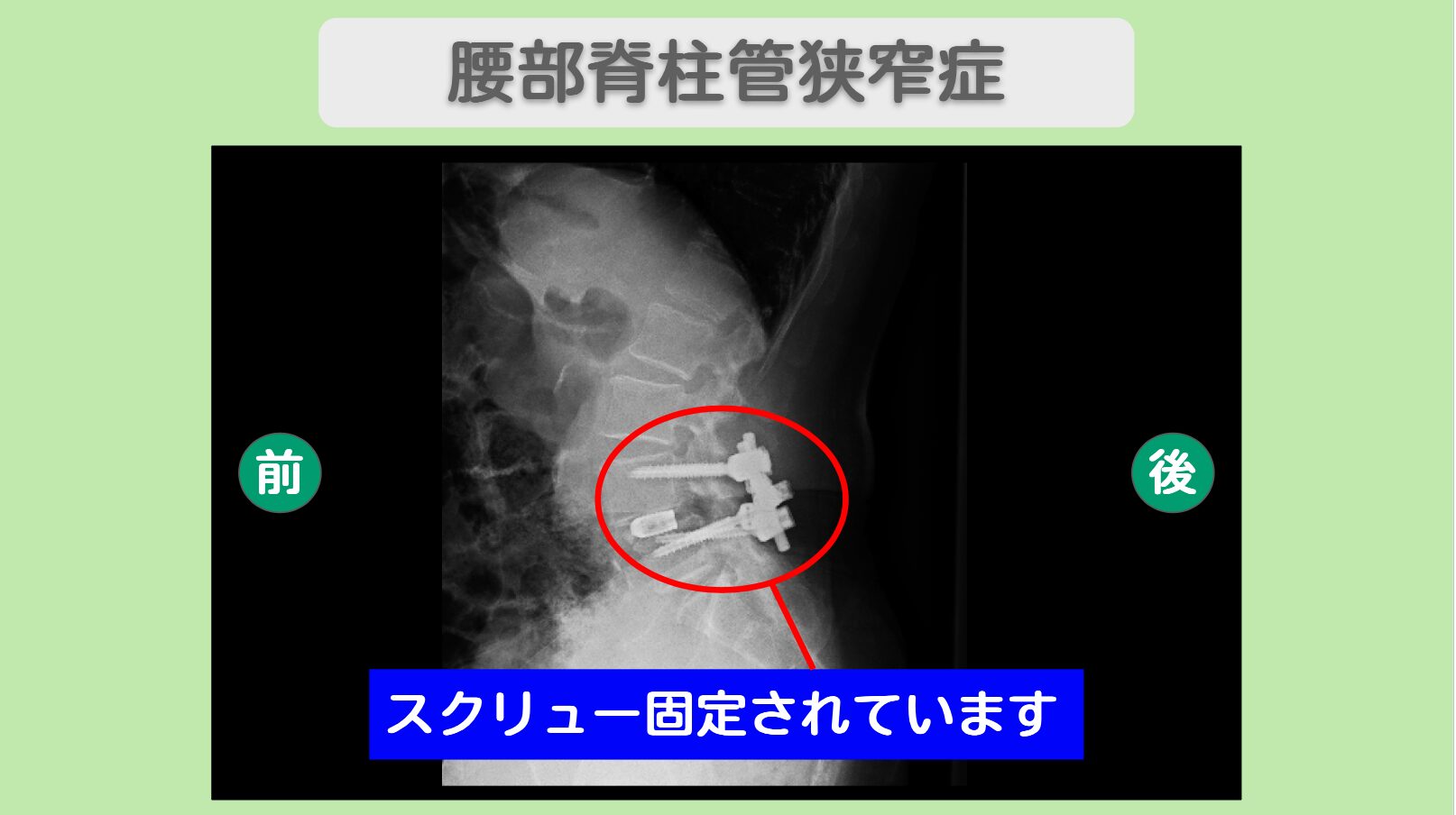 腰部脊柱管狭窄症