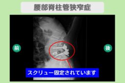 腰部脊柱管狭窄症
