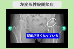 左変形性股関節症（臼蓋形成不全）