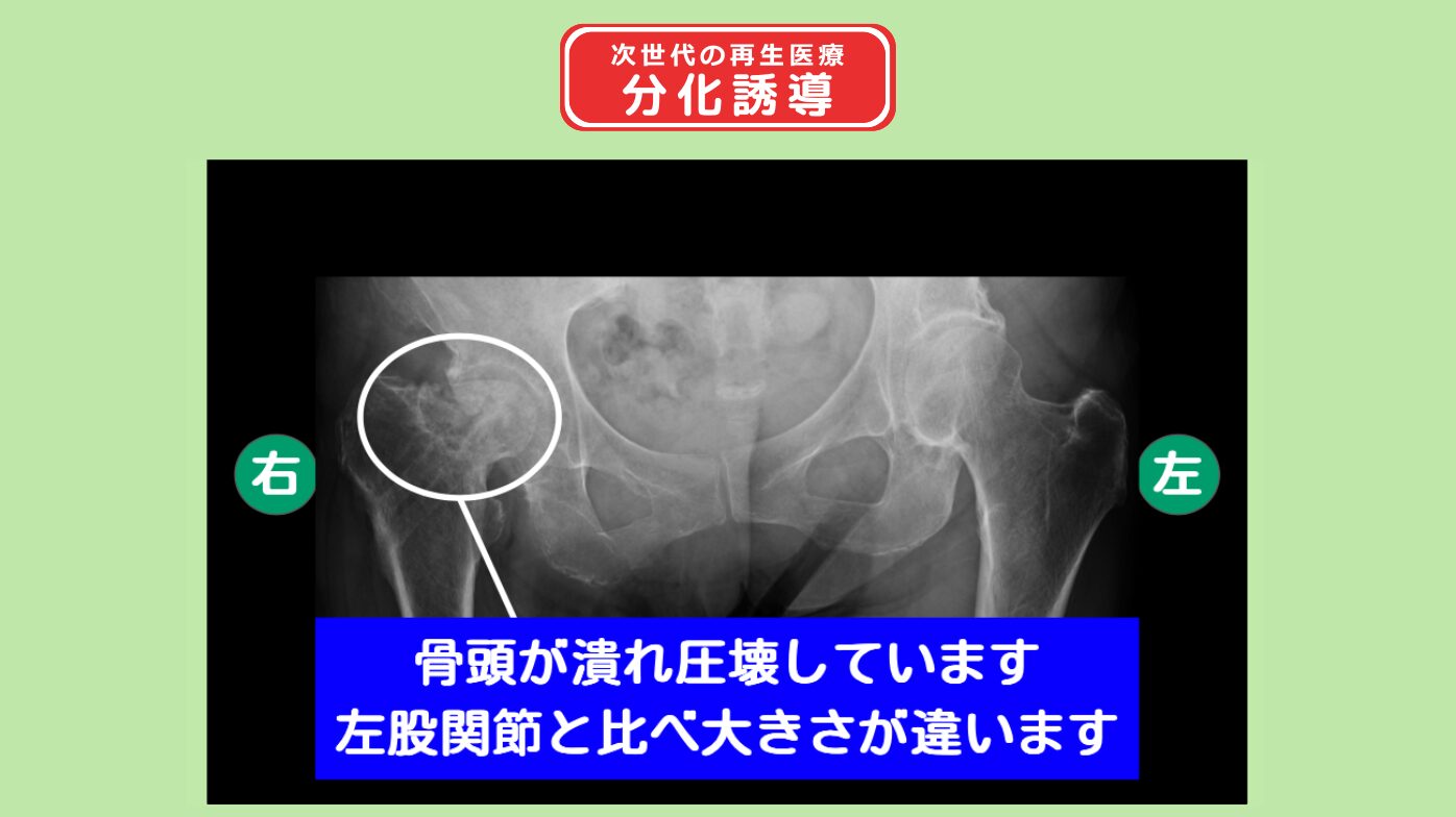 右大腿骨頭壊死症