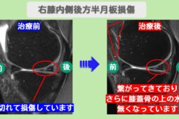 半月板損傷