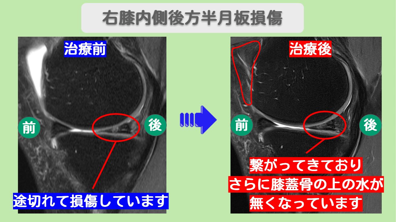 半月板損傷