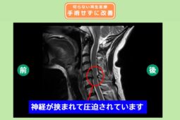 頸椎症性脊髄症