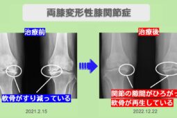 変形性膝関節症ビフォーアフター