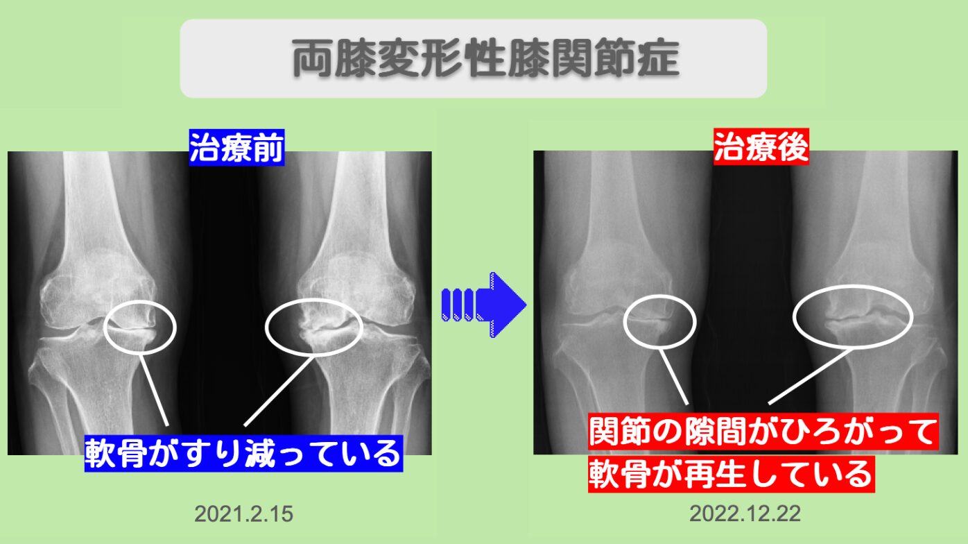 変形性膝関節症ビフォーアフター