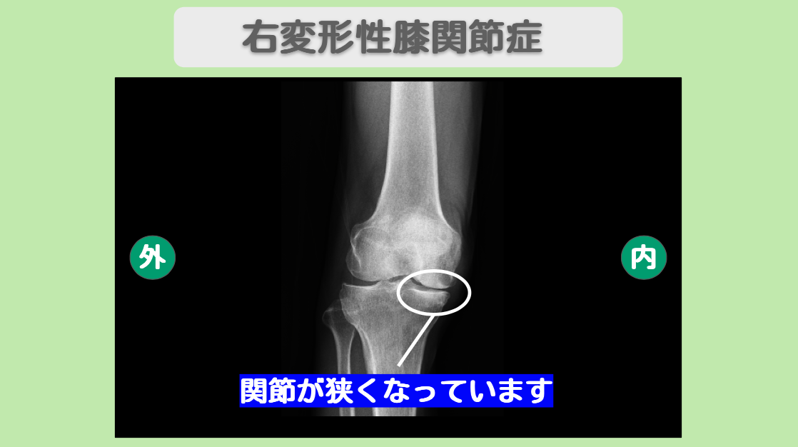 右変形性膝関節症