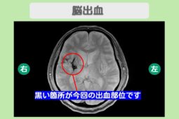 脳出血