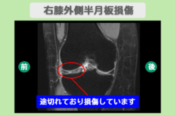 半月板損傷