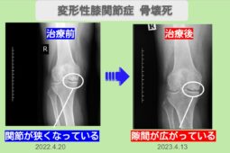 変形性膝関節症