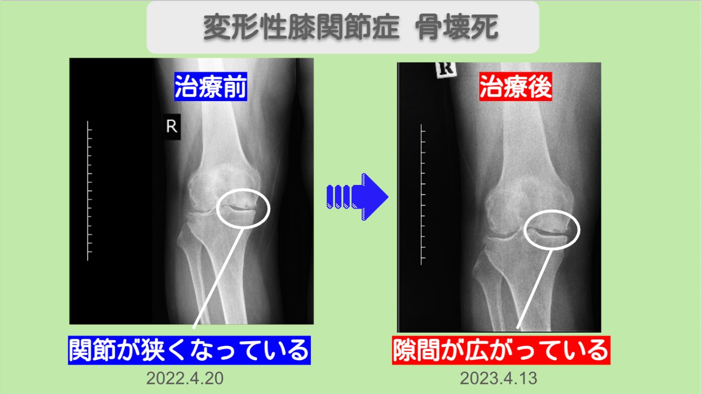 変形性膝関節症