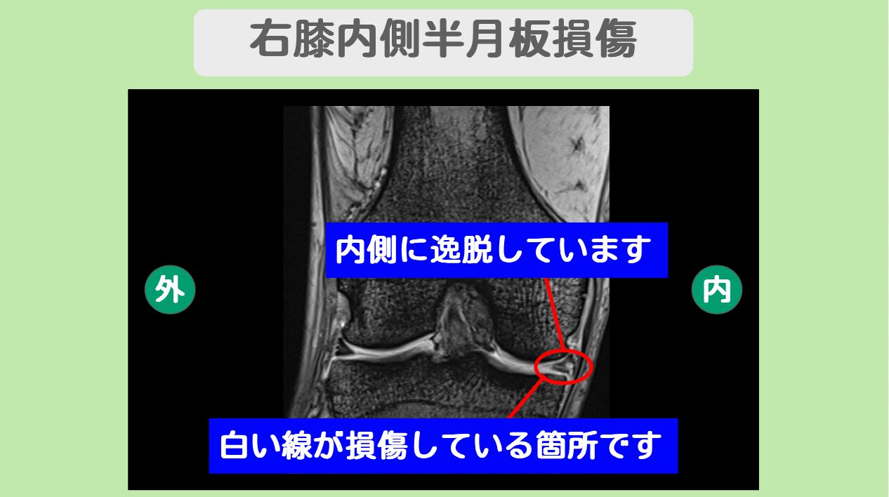 半月板損傷