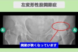 変形性股関節症