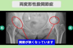 変形性股関節症