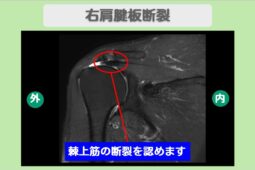 右肩腱板損傷
