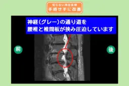 脊柱管狭窄症