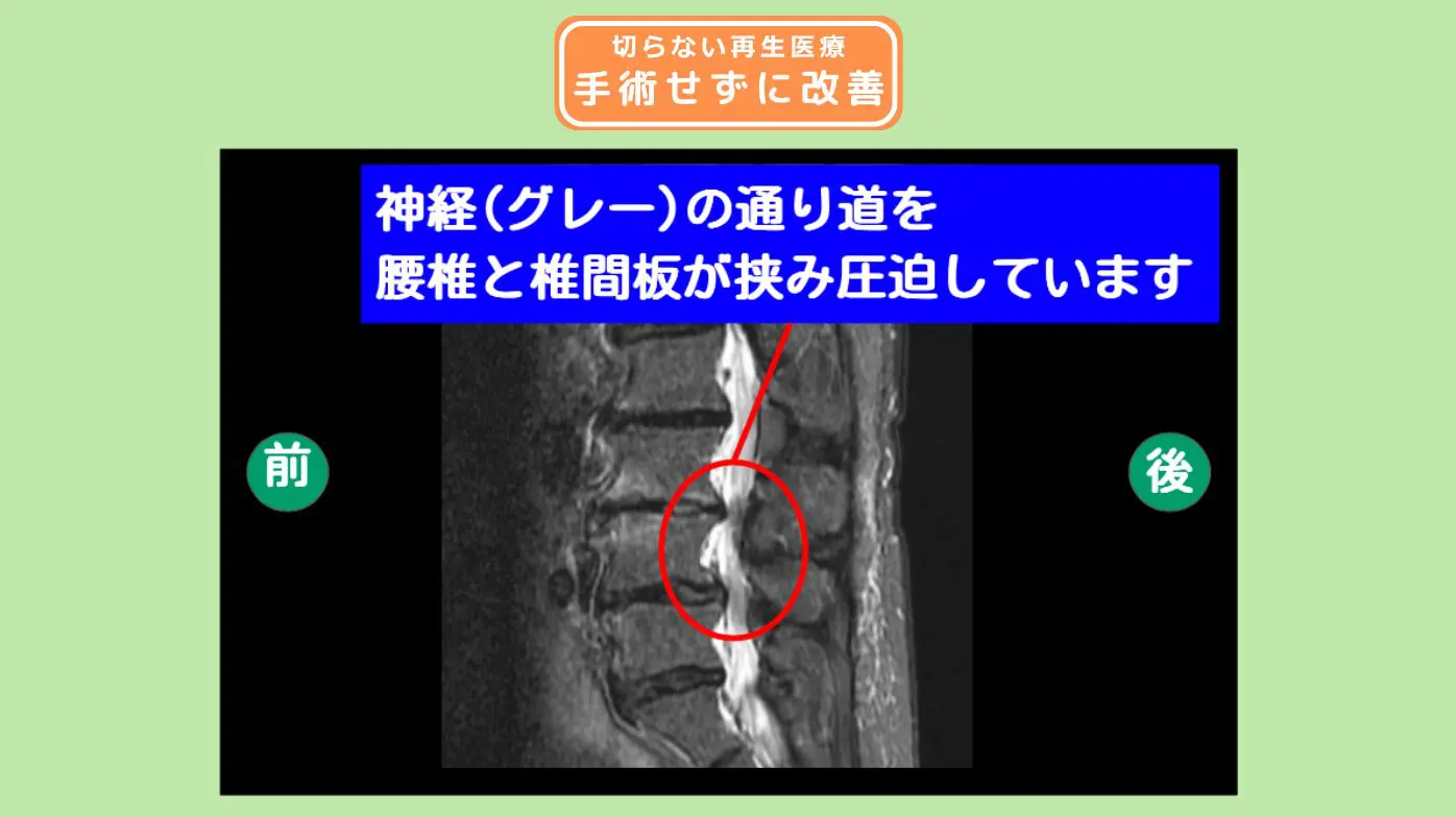 脊柱管狭窄症