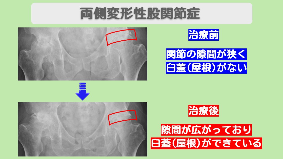 変形性股関節症