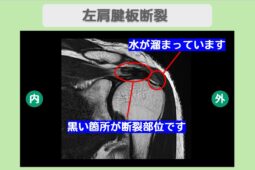 肩腱板断裂