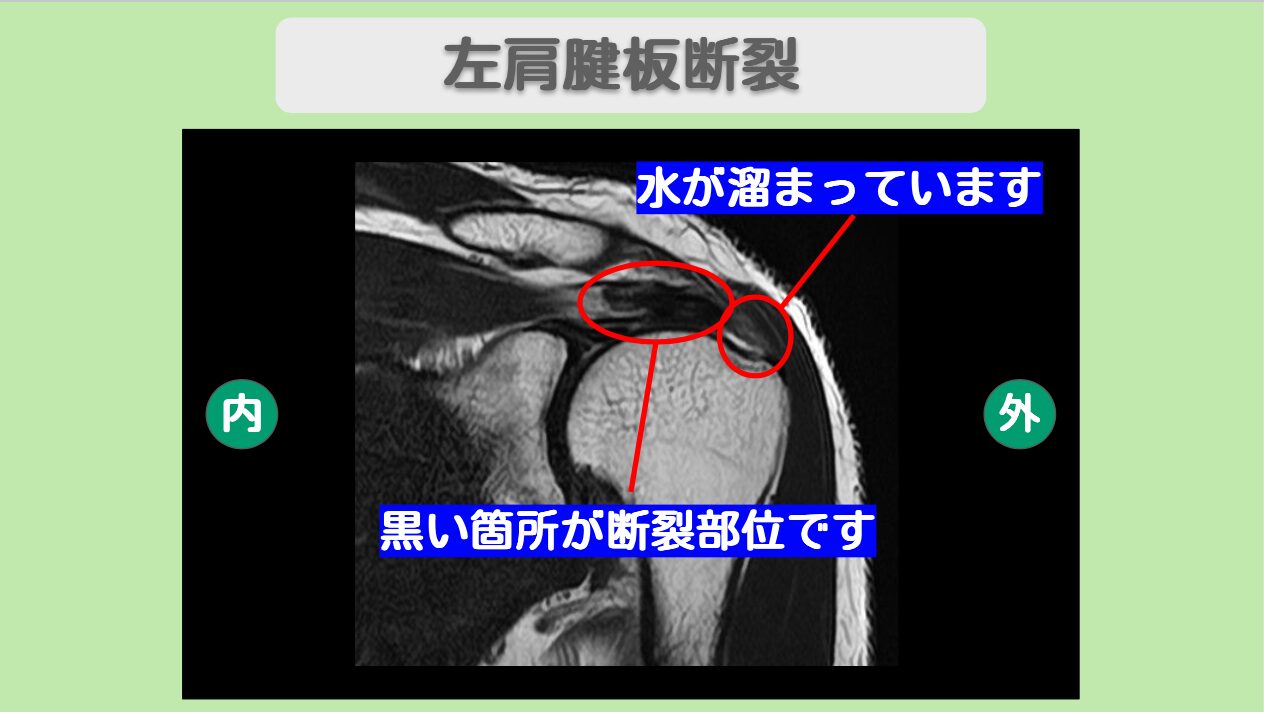 肩腱板断裂