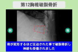胸髄損傷