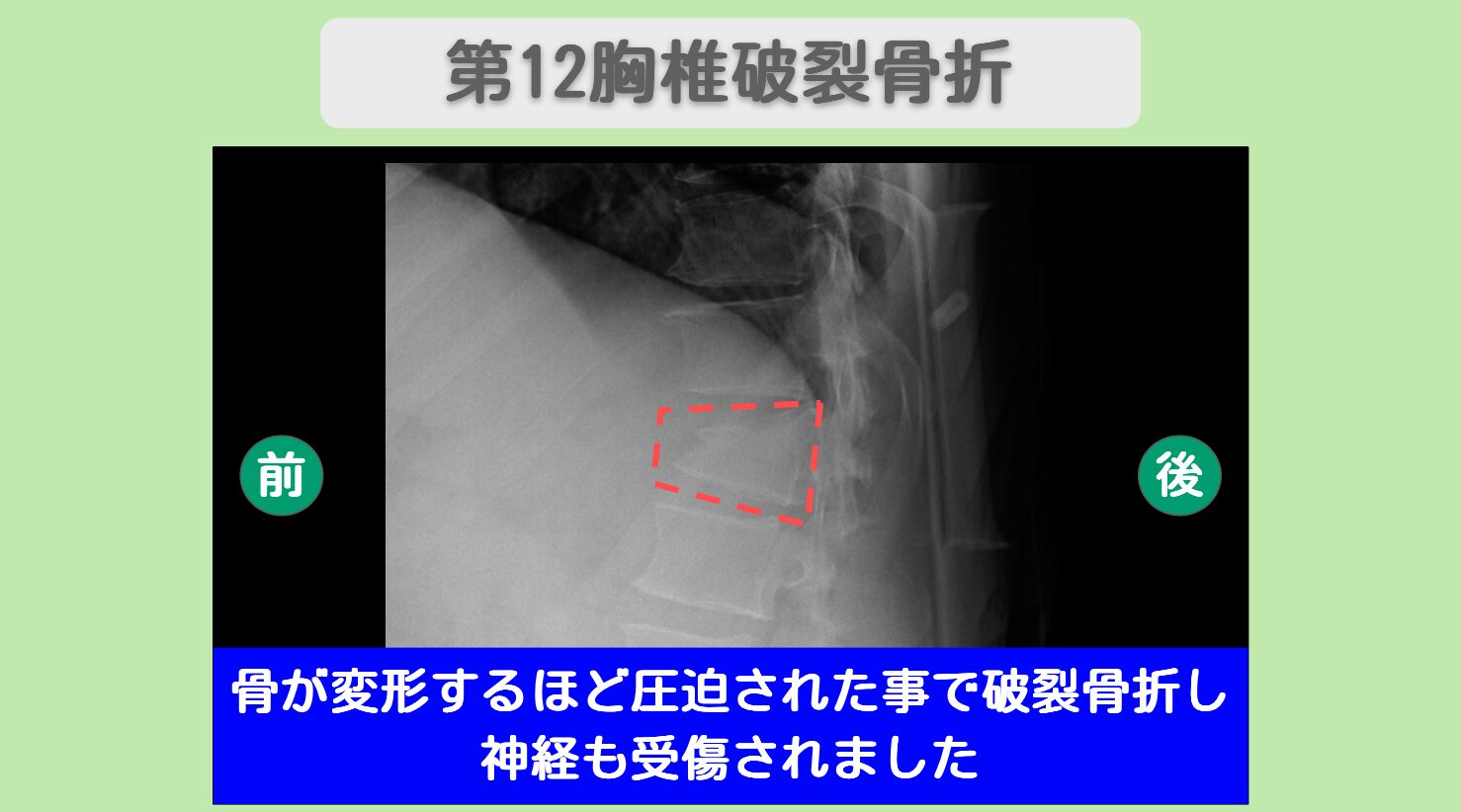 胸髄損傷