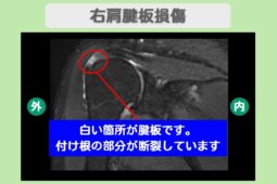 肩腱板損傷