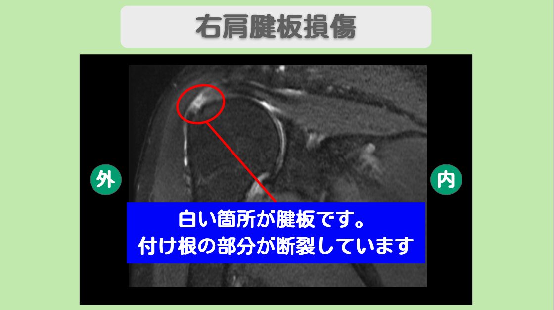 肩腱板損傷