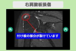 肩腱板損傷