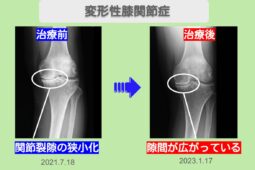 変形性膝関節症