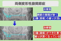 両変形性股関節症