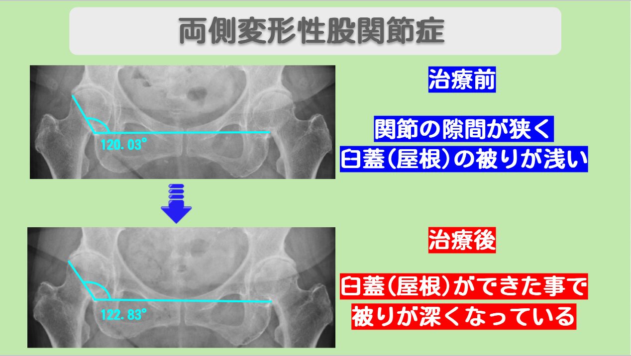 両変形性股関節症