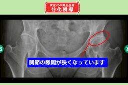 変形性股関節症