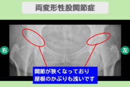 変形性股関節症