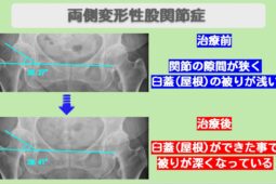 変形性股関節症