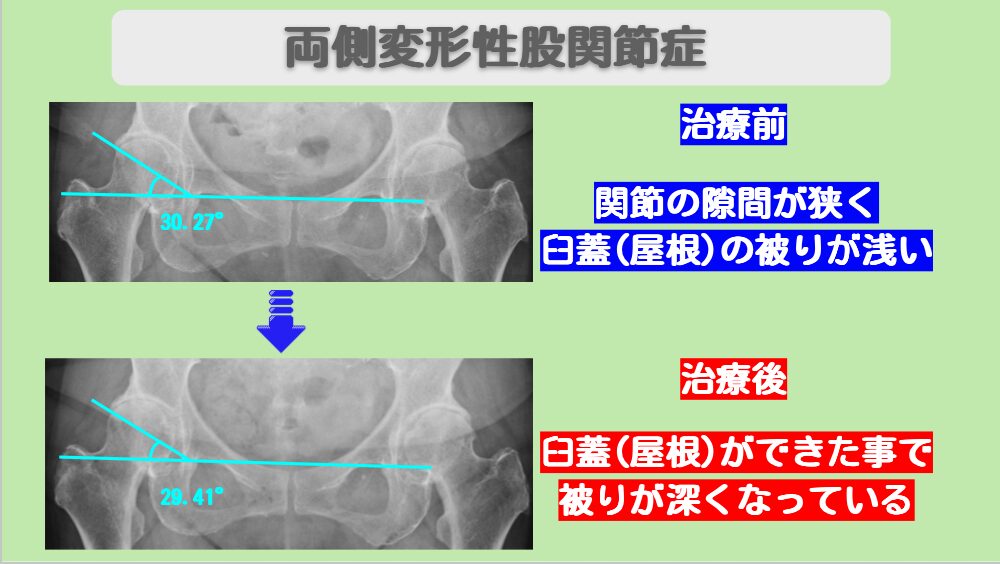 変形性股関節症