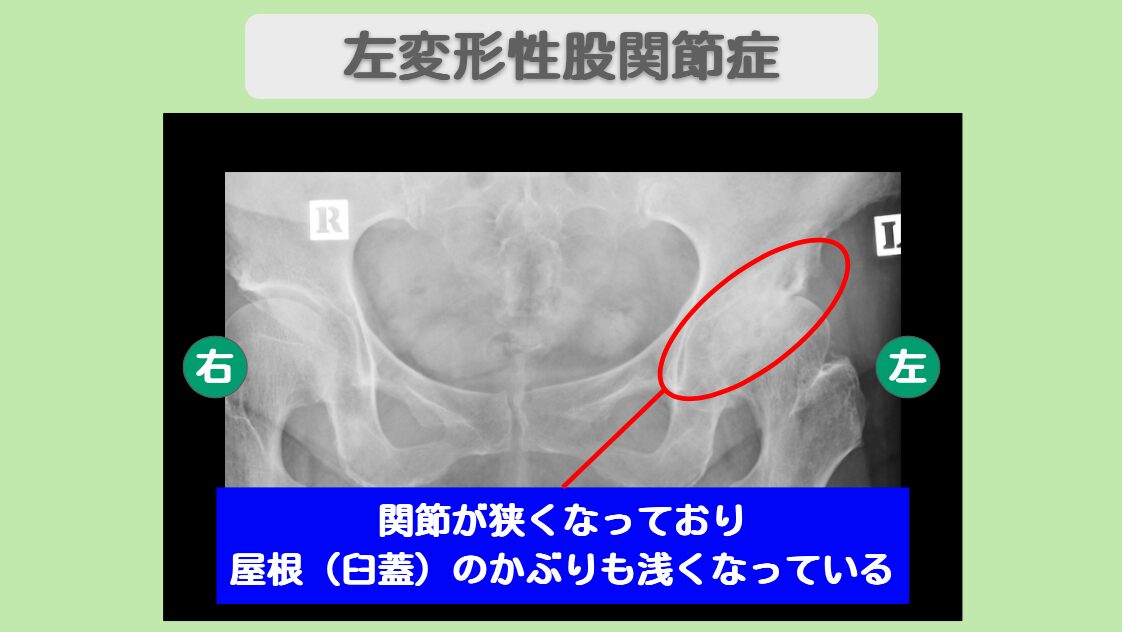 変形性股関節症
