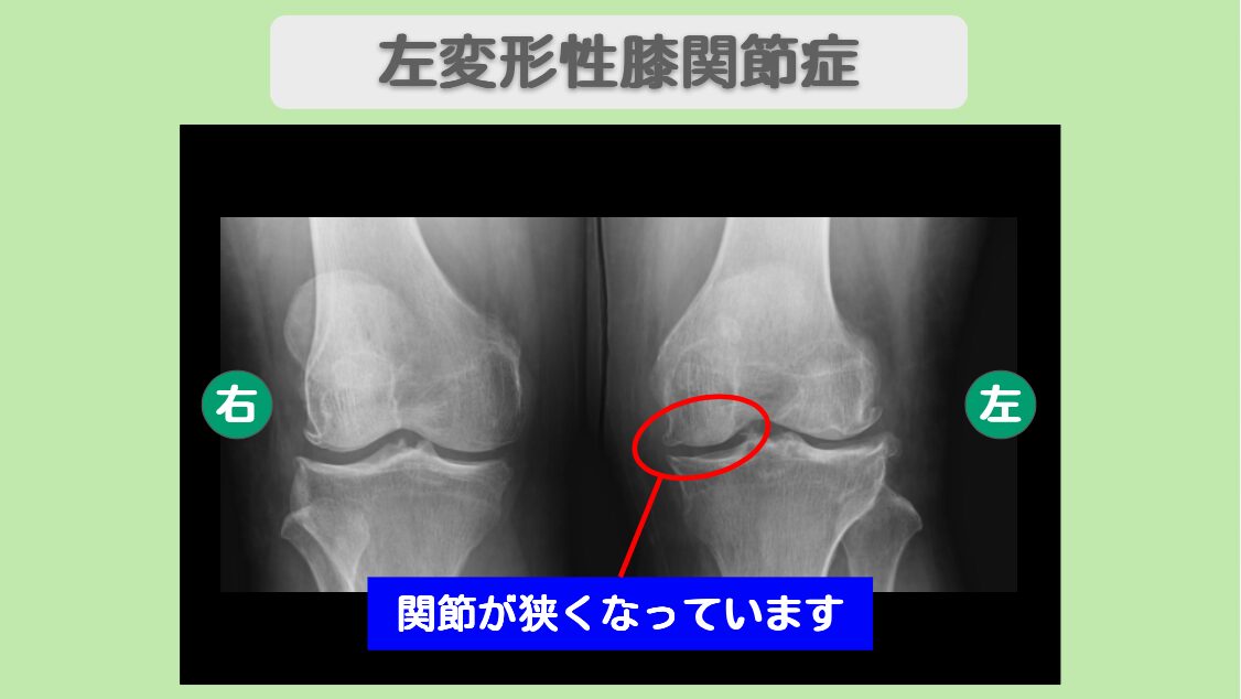 変形性膝関節症