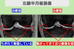 半月板損傷