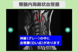 頚髄内海綿状血管腫