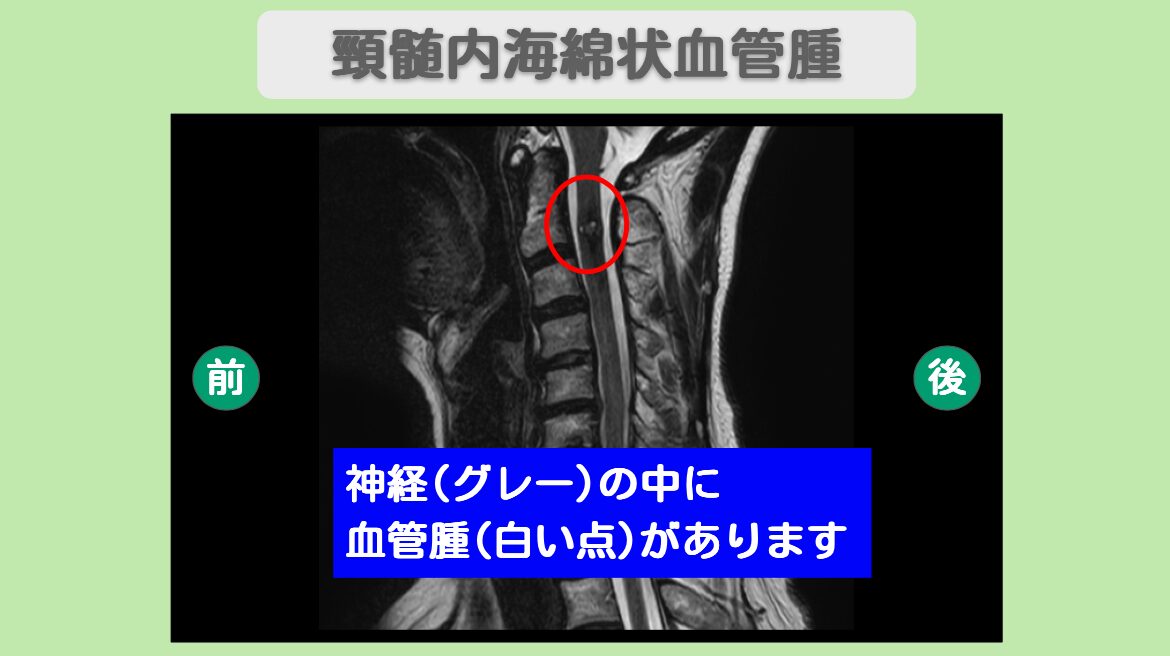 頚髄内海綿状血管腫