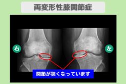両変形性膝関節症