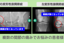 変形性股関節症，変形性膝関節症