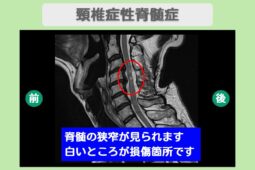 頚椎症性脊髄症