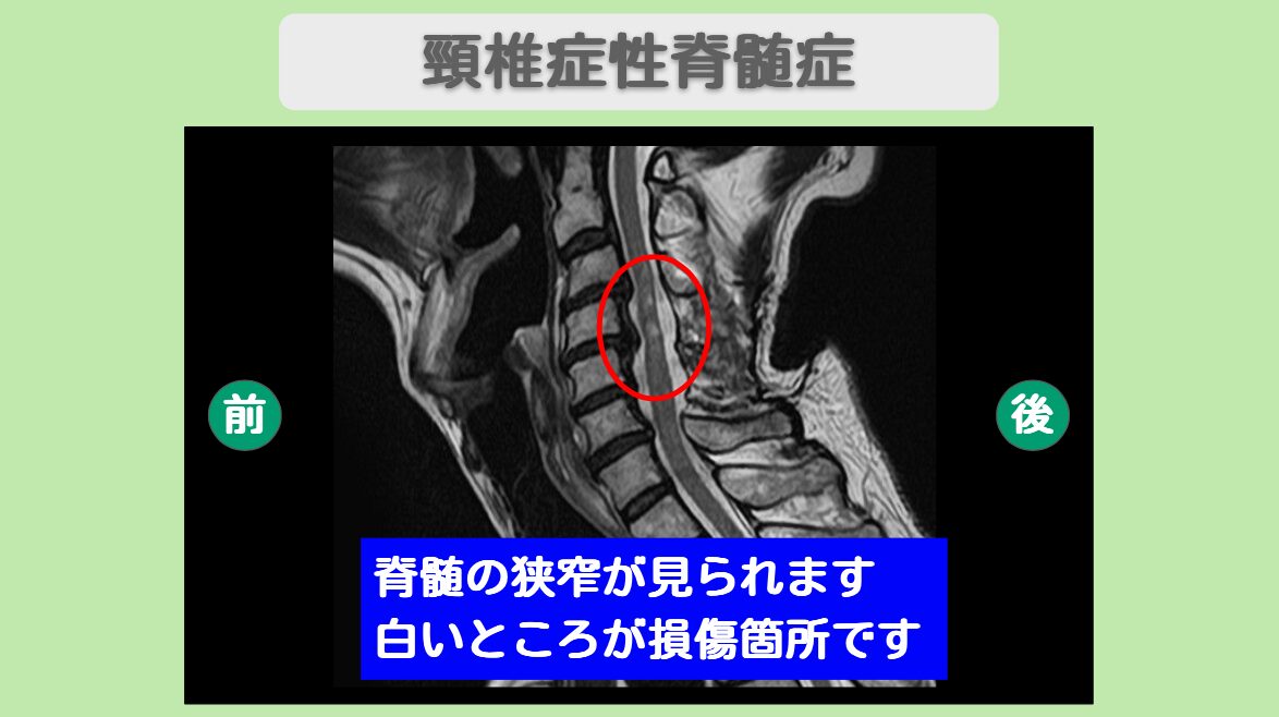 頚椎症性脊髄症