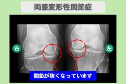 変形性関節症