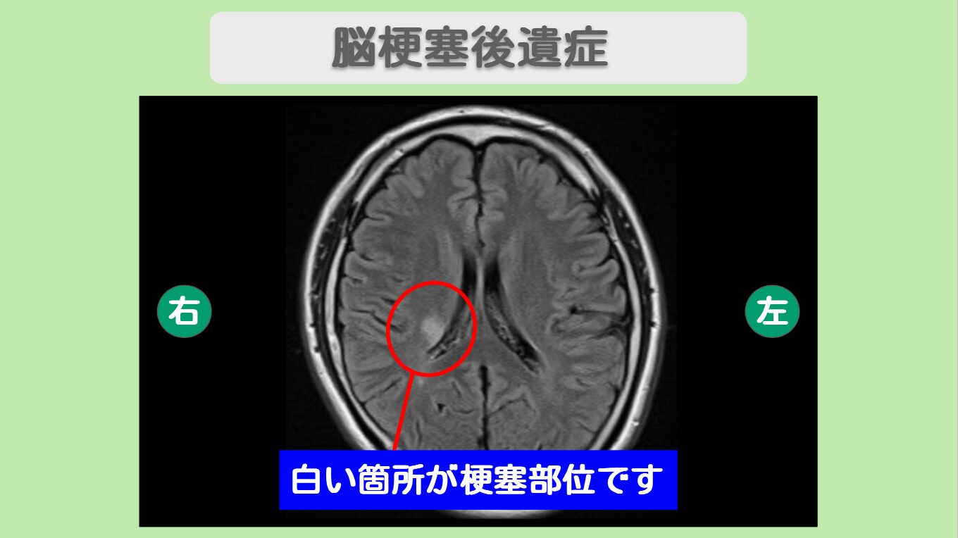脳梗塞