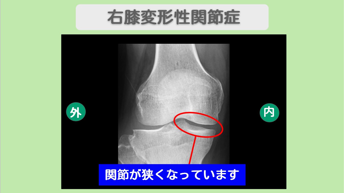 半月板損傷　