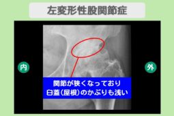 変形性股関節症